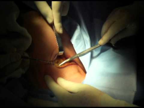 Prótesis mamaria por vía axilar