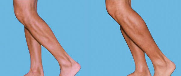 Aumento de gemelos: la nueva tendencia en cirugía estética