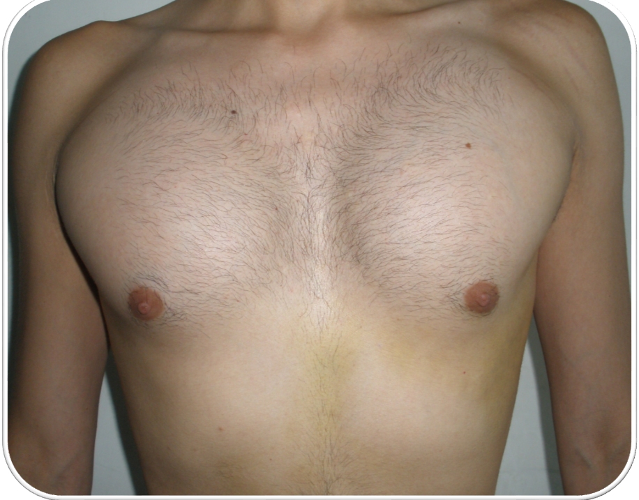 Implante pectoral