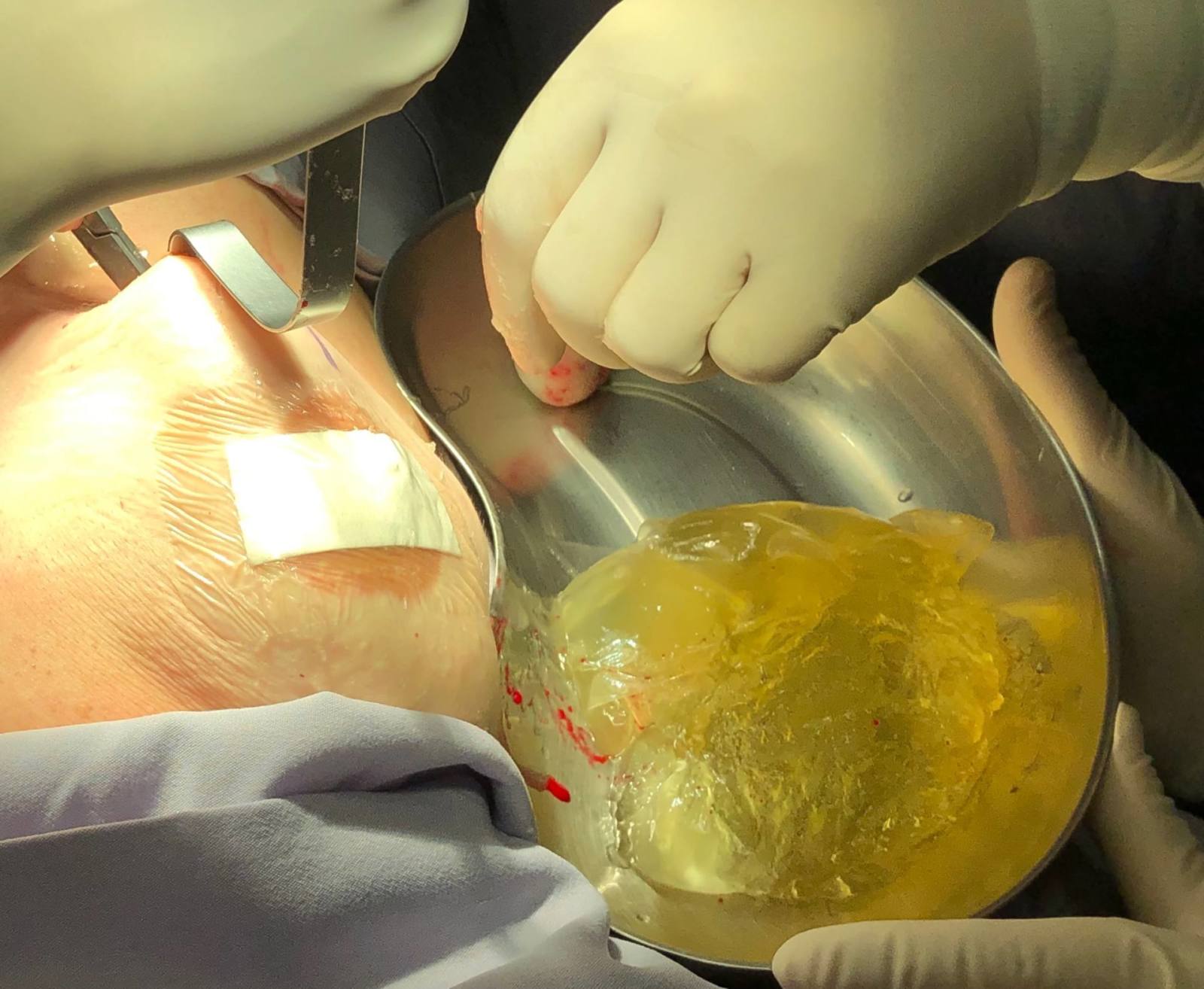 Implantes rotos
