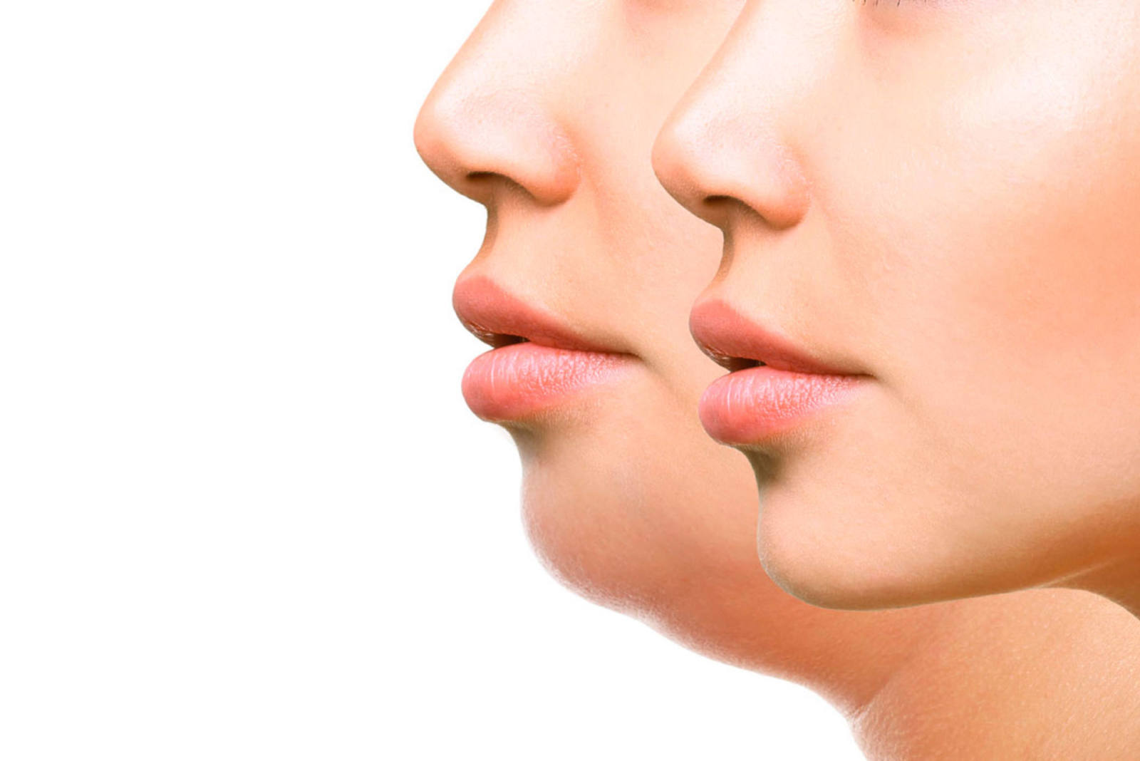 Perfiloplastia: rompiendo mitos de la cirugía facial