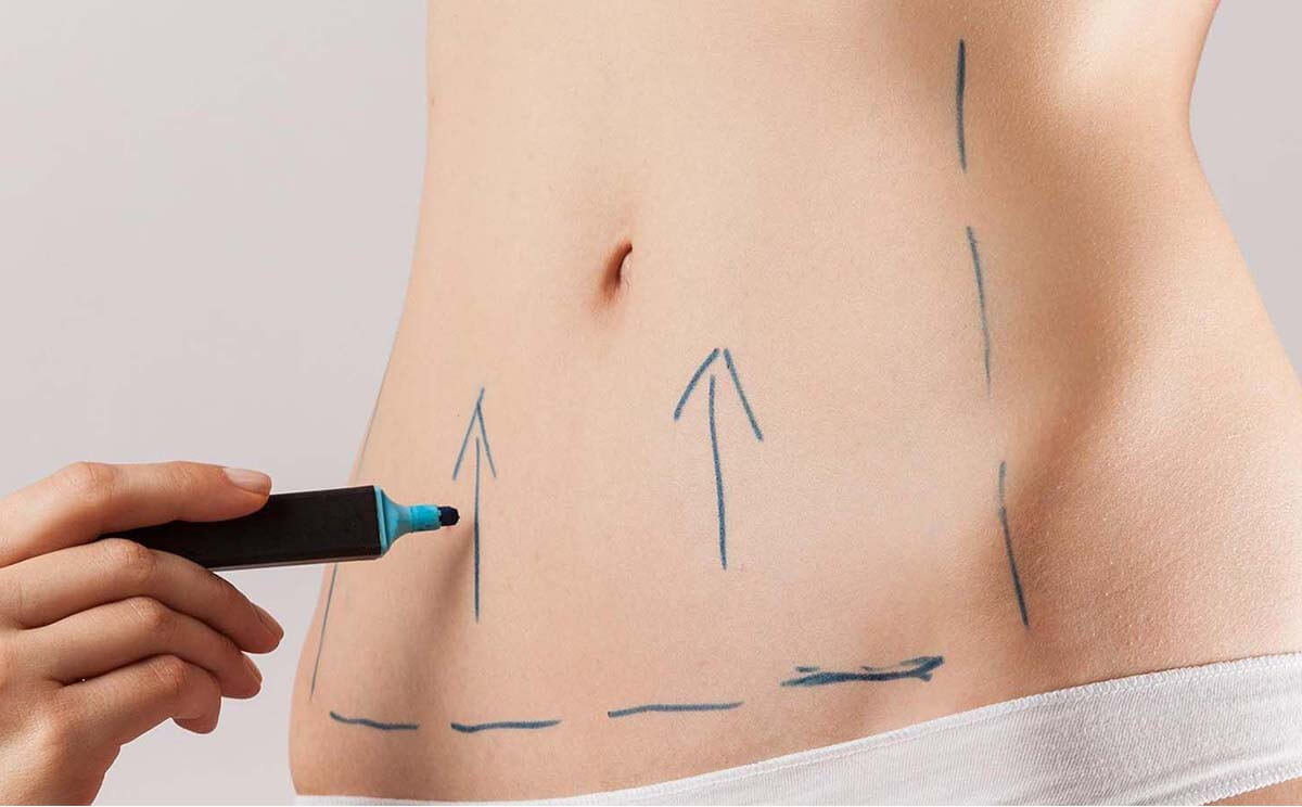 La abdominoplastia y los riesgos de fumar