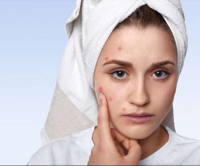 ¿Cuáles son las causas del acné?