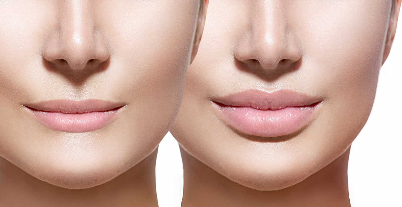 Aumento de labios con ácido hialurónico: un tratamiento 100% biocompatible