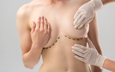 Por qué deberías realizarte una mamoplastia de reducción