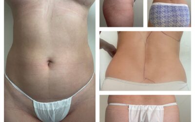 Casos clínicos, Liposucción y Abdominoplastía