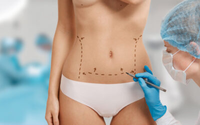 Abdominoplastia: ¿por qué realizársela?