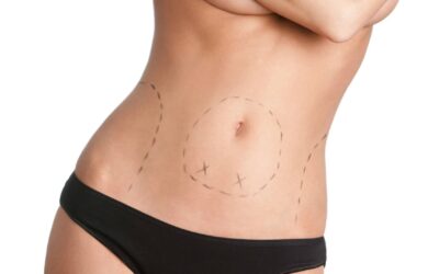 Destapando mitos de la abdominoplastia