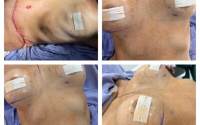 Pérdida excesiva de peso, abdominoplastia e implante de mama