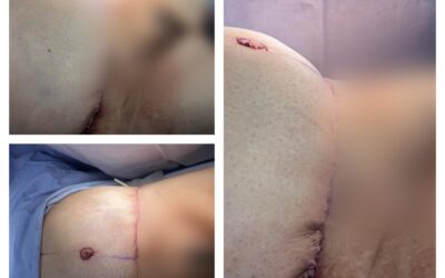 Abdominoplastia
