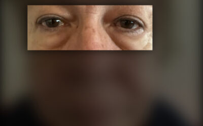Blefaroplastia estética