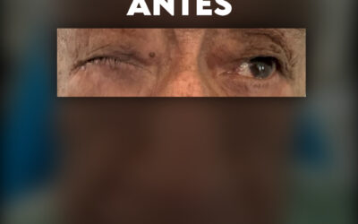 Blefaroplastia reconstructiva, ptosis palpebral