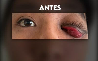 Tumoración palpebral